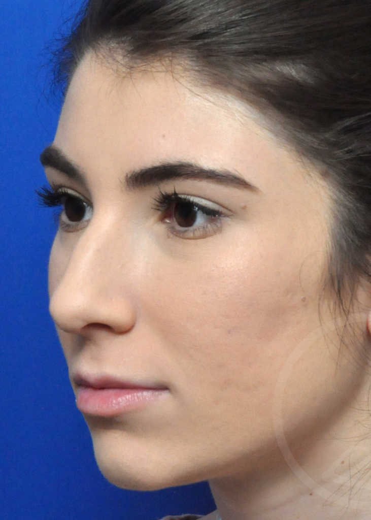 Plastic Surgery Before and After Pictures in Jacksonville, FL - Garcia Facial Plastic Surgery