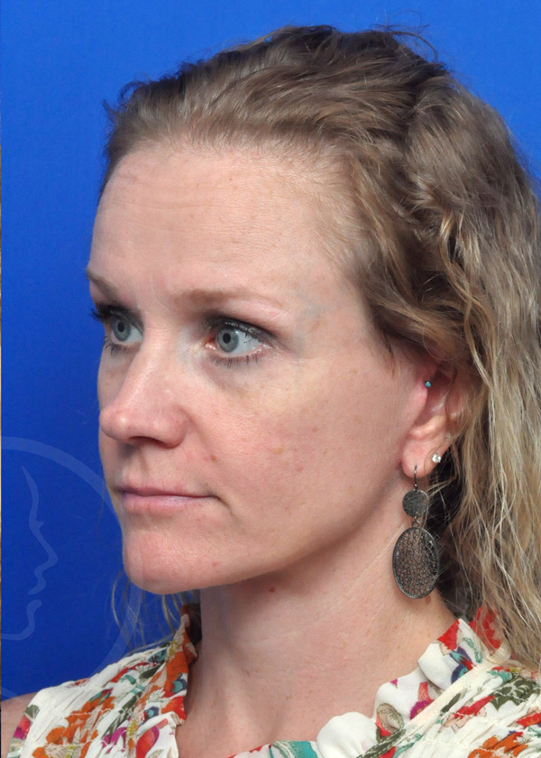Plastic Surgery Before and After Pictures in Jacksonville, FL - Garcia Facial Plastic Surgery