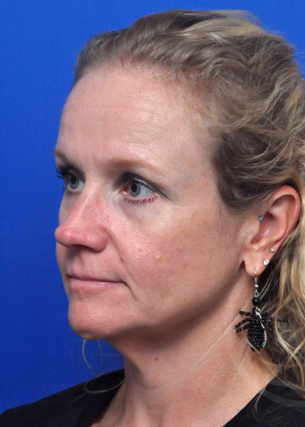 Plastic Surgery Before and After Pictures in Jacksonville, FL - Garcia Facial Plastic Surgery