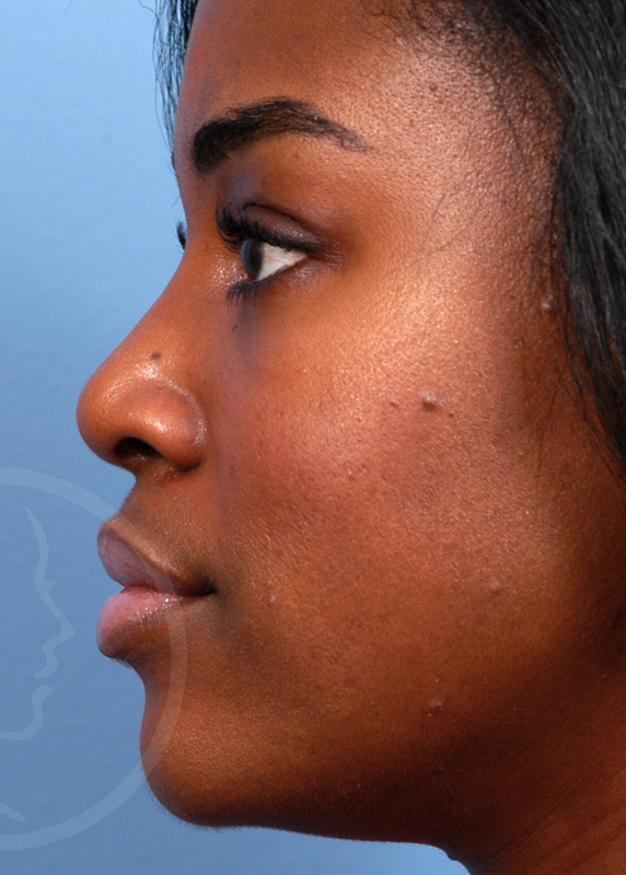 Plastic Surgery Before and After Pictures in Jacksonville, FL - Garcia Facial Plastic Surgery