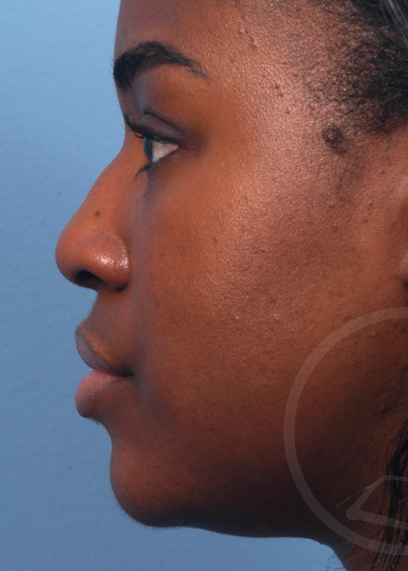 Plastic Surgery Before and After Pictures in Jacksonville, FL - Garcia Facial Plastic Surgery