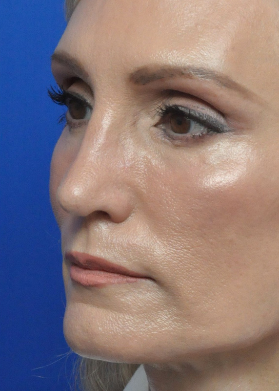 Plastic Surgery Before and After Pictures in Jacksonville, FL - Garcia Facial Plastic Surgery