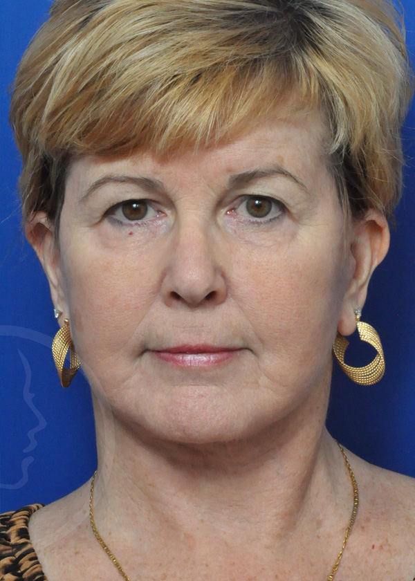 Plastic Surgery Before and After Pictures in Jacksonville, FL - Garcia Facial Plastic Surgery