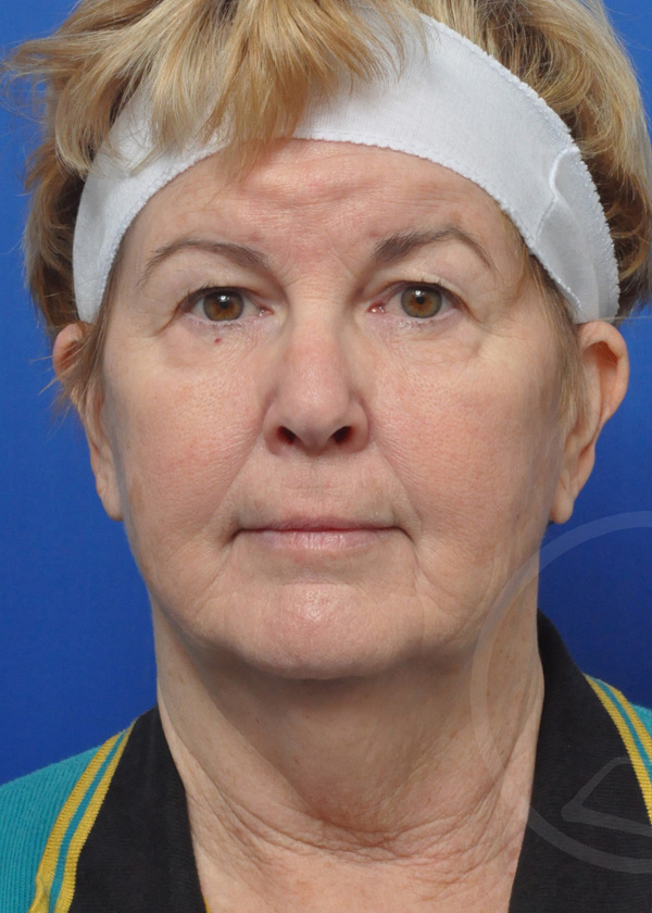 Plastic Surgery Before and After Pictures in Jacksonville, FL - Garcia Facial Plastic Surgery