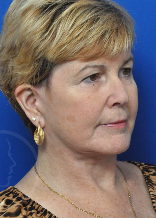 Plastic Surgery Before and After Pictures in Jacksonville, FL - Garcia Facial Plastic Surgery