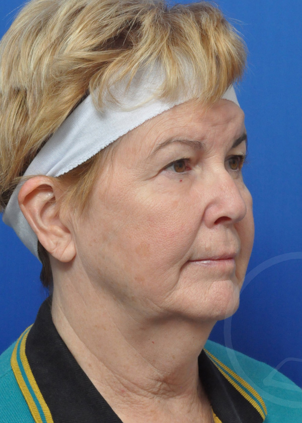 Plastic Surgery Before and After Pictures in Jacksonville, FL - Garcia Facial Plastic Surgery