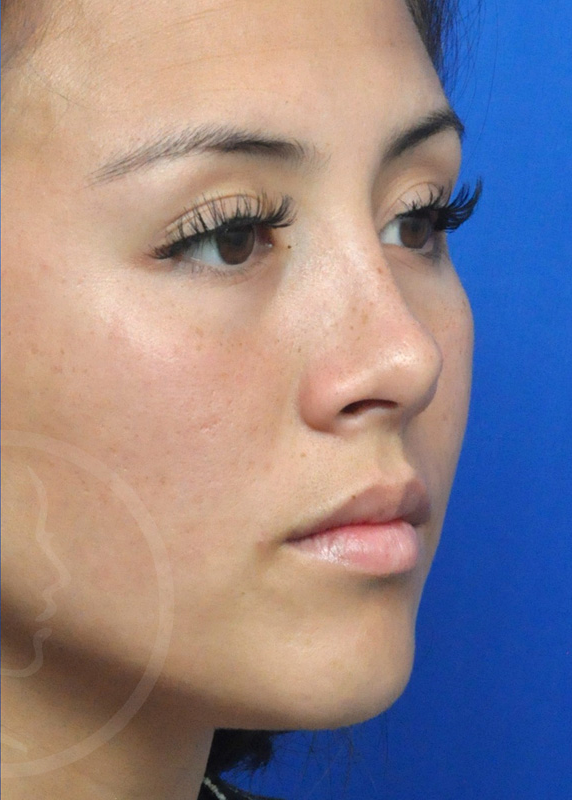 Plastic Surgery Before and After Pictures in Jacksonville, FL - Garcia Facial Plastic Surgery