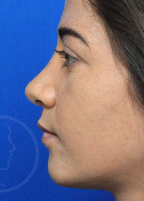 Plastic Surgery Before and After Pictures in Jacksonville, FL - Garcia Facial Plastic Surgery