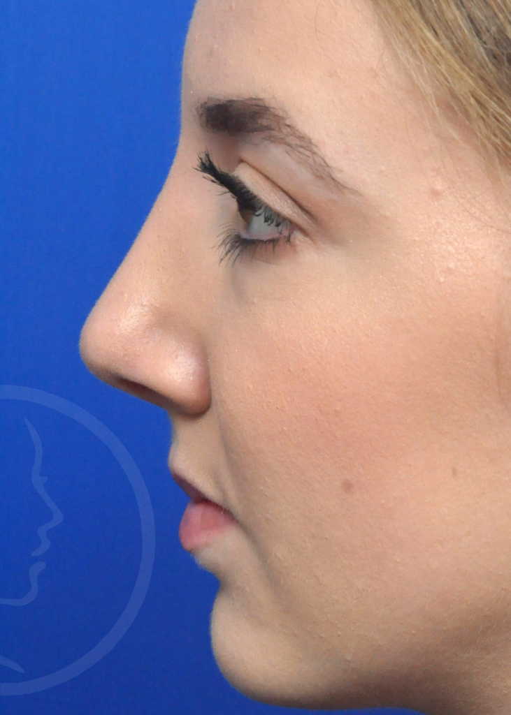 Plastic Surgery Before and After Pictures in Jacksonville, FL - Garcia Facial Plastic Surgery