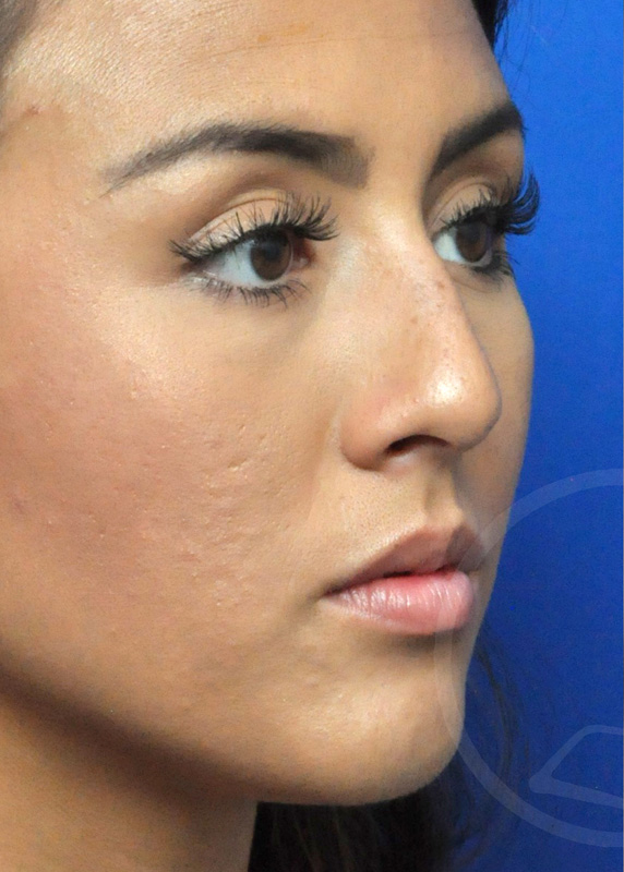 Plastic Surgery Before and After Pictures in Jacksonville, FL - Garcia Facial Plastic Surgery