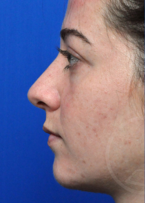 Plastic Surgery Before and After Pictures in Jacksonville, FL - Garcia Facial Plastic Surgery