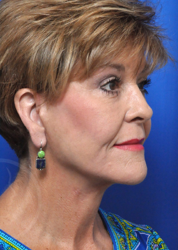 Plastic Surgery Before and After Pictures in Jacksonville, FL - Garcia Facial Plastic Surgery