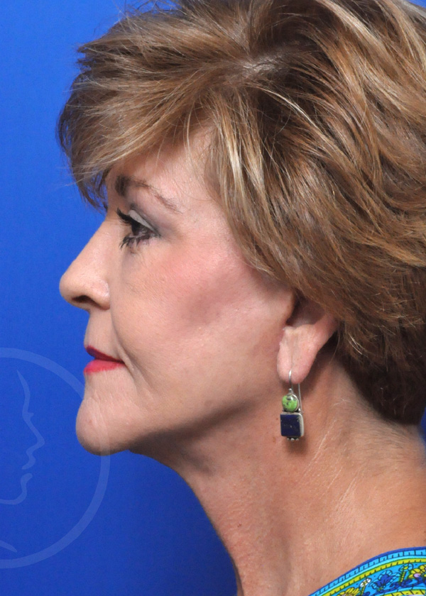 Plastic Surgery Before and After Pictures in Jacksonville, FL - Garcia Facial Plastic Surgery