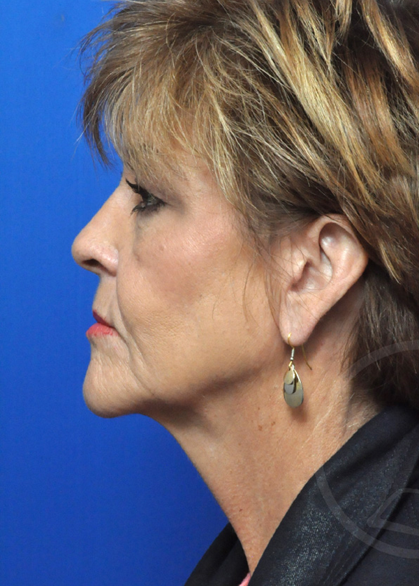Plastic Surgery Before and After Pictures in Jacksonville, FL - Garcia Facial Plastic Surgery