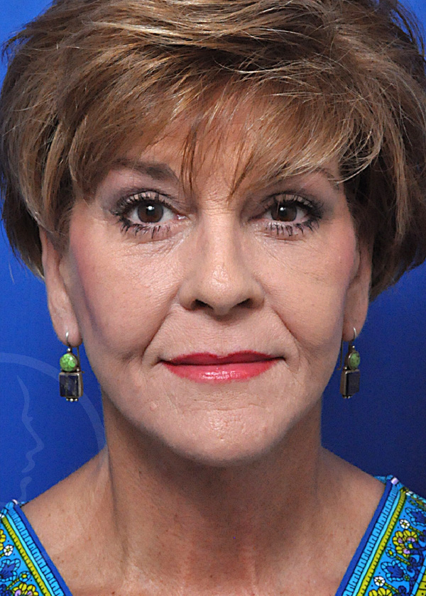 Plastic Surgery Before and After Pictures in Jacksonville, FL - Garcia Facial Plastic Surgery