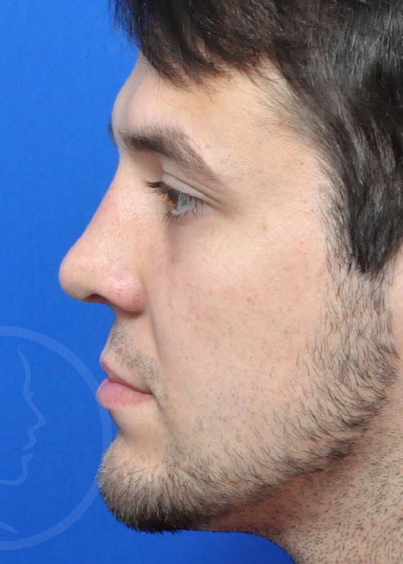 Plastic Surgery Before and After Pictures in Jacksonville, FL - Garcia Facial Plastic Surgery