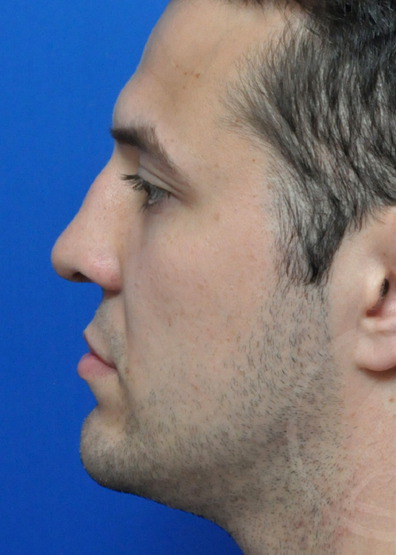 Plastic Surgery Before and After Pictures in Jacksonville, FL - Garcia Facial Plastic Surgery