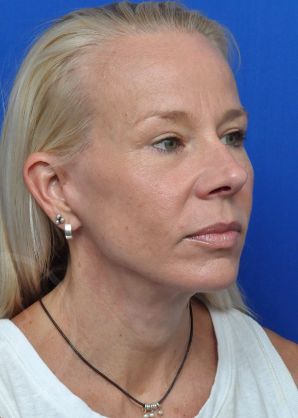 Plastic Surgery Before and After Pictures in Jacksonville, FL - Garcia Facial Plastic Surgery