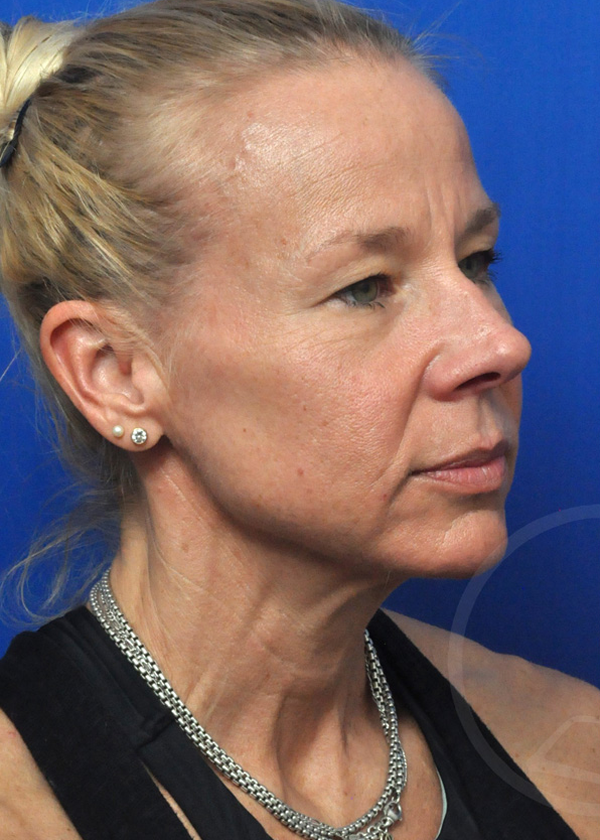Plastic Surgery Before and After Pictures in Jacksonville, FL - Garcia Facial Plastic Surgery