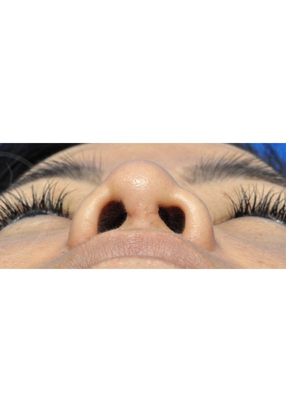 Plastic Surgery Before and After Pictures in Jacksonville, FL - Garcia Facial Plastic Surgery