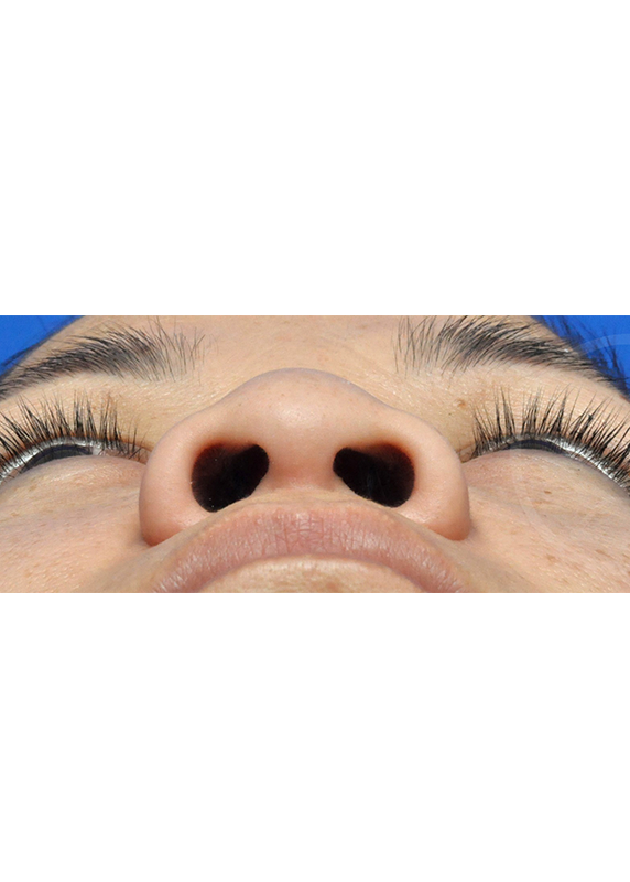 Plastic Surgery Before and After Pictures in Jacksonville, FL - Garcia Facial Plastic Surgery