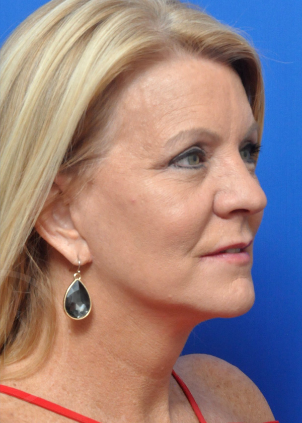 Plastic Surgery Before and After Pictures in Jacksonville, FL - Garcia Facial Plastic Surgery