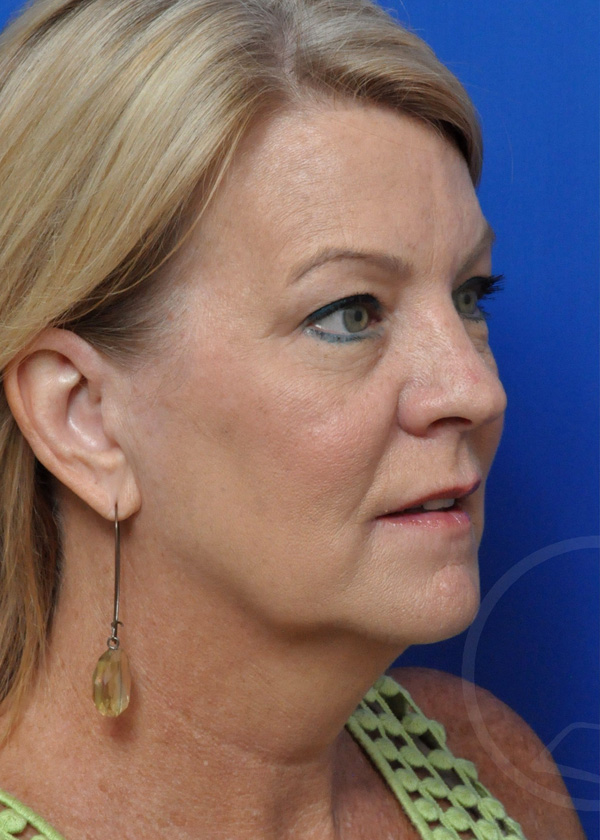 Plastic Surgery Before and After Pictures in Jacksonville, FL - Garcia Facial Plastic Surgery