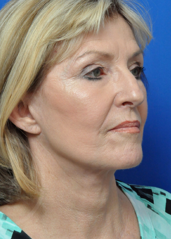 Plastic Surgery Before and After Pictures in Jacksonville, FL - Garcia Facial Plastic Surgery