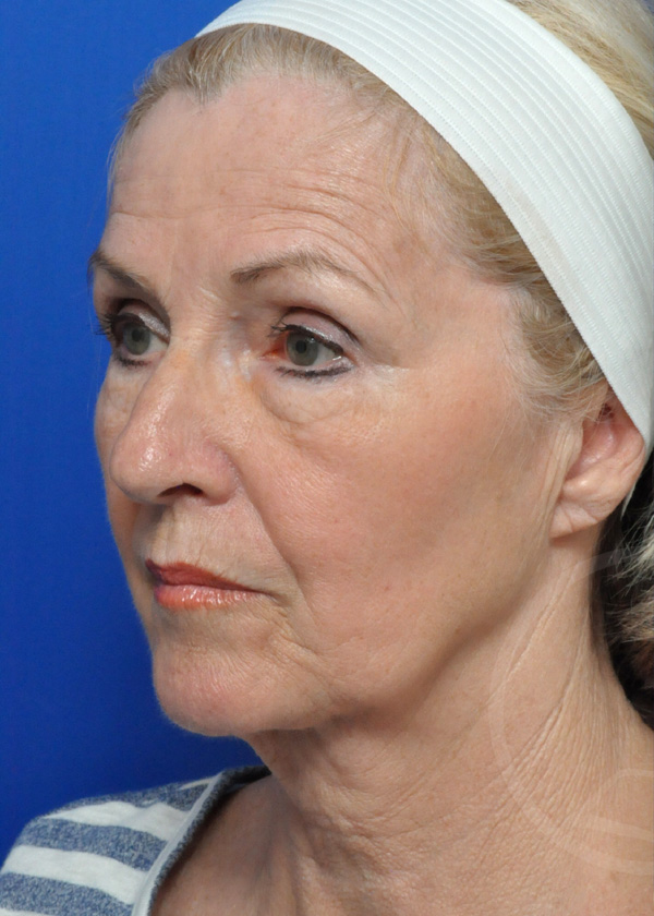 Plastic Surgery Before and After Pictures in Jacksonville, FL - Garcia Facial Plastic Surgery