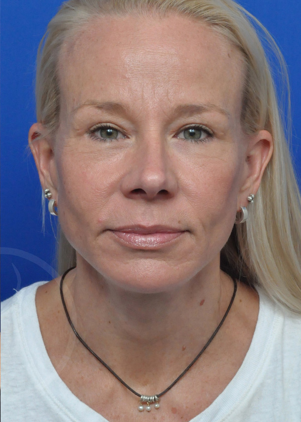 Plastic Surgery Before and After Pictures in Jacksonville, FL - Garcia Facial Plastic Surgery