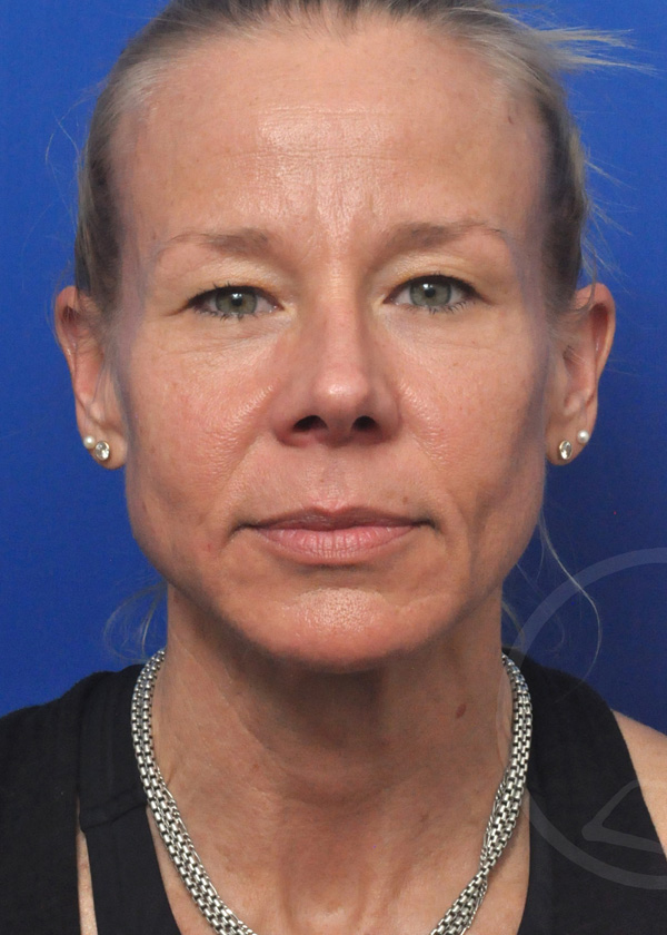 Plastic Surgery Before and After Pictures in Jacksonville, FL - Garcia Facial Plastic Surgery