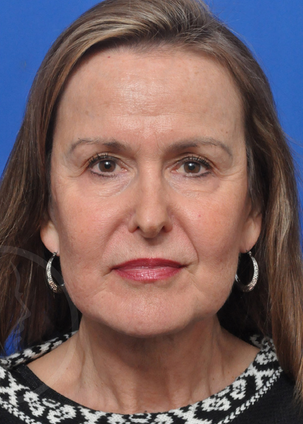 Plastic Surgery Before and After Pictures in Jacksonville, FL - Garcia Facial Plastic Surgery