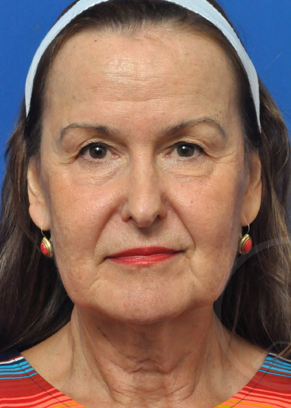 Plastic Surgery Before and After Pictures in Jacksonville, FL - Garcia Facial Plastic Surgery