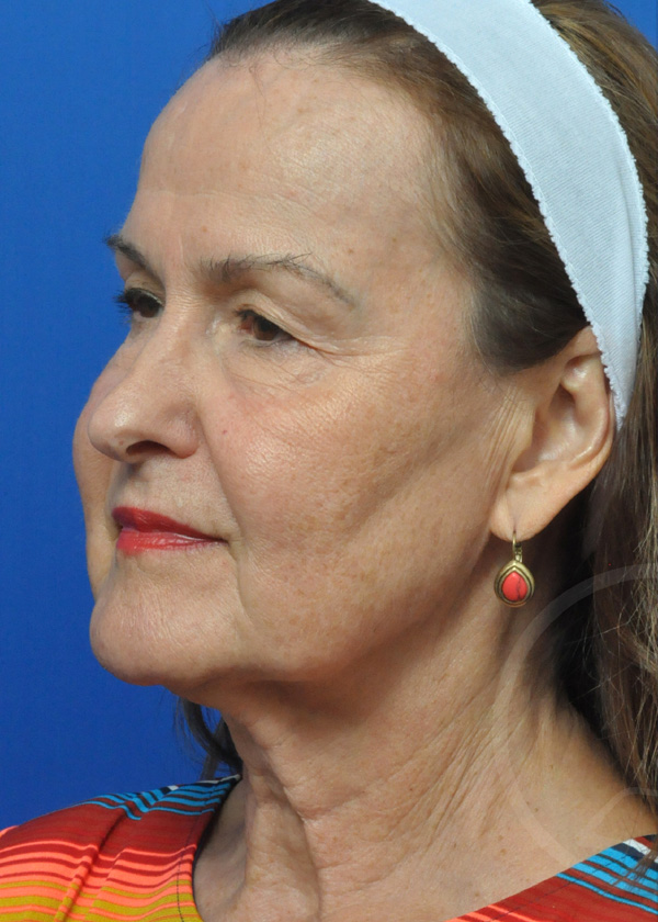 Plastic Surgery Before and After Pictures in Jacksonville, FL - Garcia Facial Plastic Surgery
