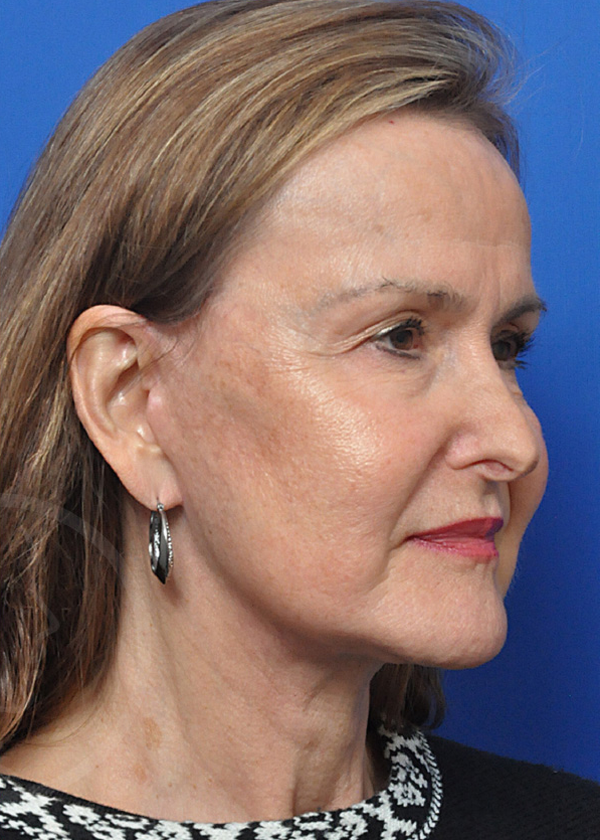 Plastic Surgery Before and After Pictures in Jacksonville, FL - Garcia Facial Plastic Surgery