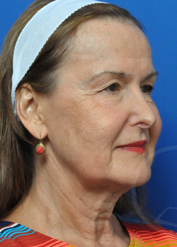 Plastic Surgery Before and After Pictures in Jacksonville, FL - Garcia Facial Plastic Surgery