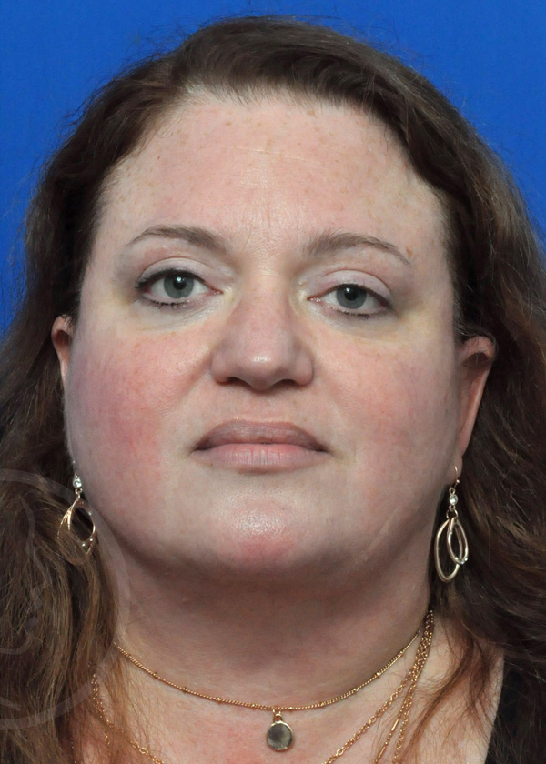 Plastic Surgery Before and After Pictures in Jacksonville, FL - Garcia Facial Plastic Surgery