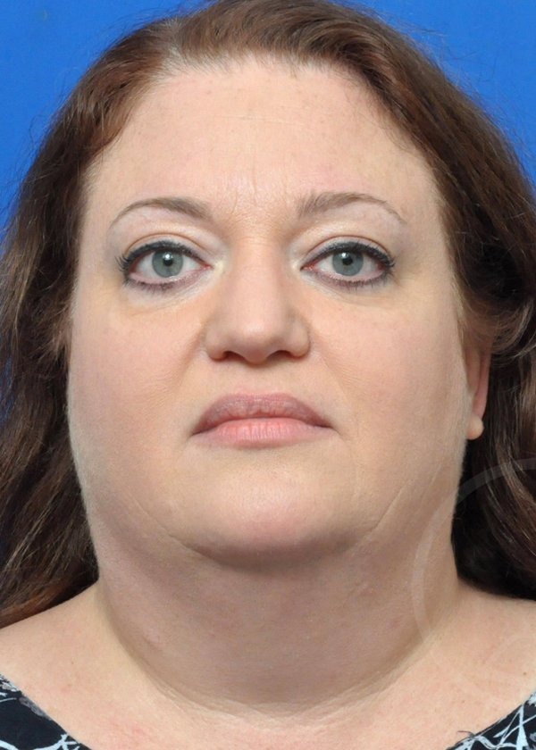 Plastic Surgery Before and After Pictures in Jacksonville, FL - Garcia Facial Plastic Surgery