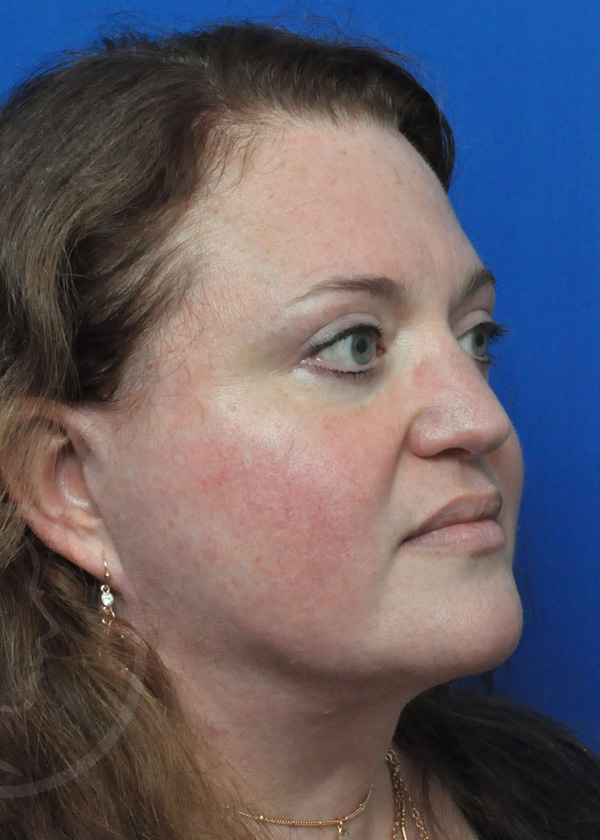 Plastic Surgery Before and After Pictures in Jacksonville, FL - Garcia Facial Plastic Surgery