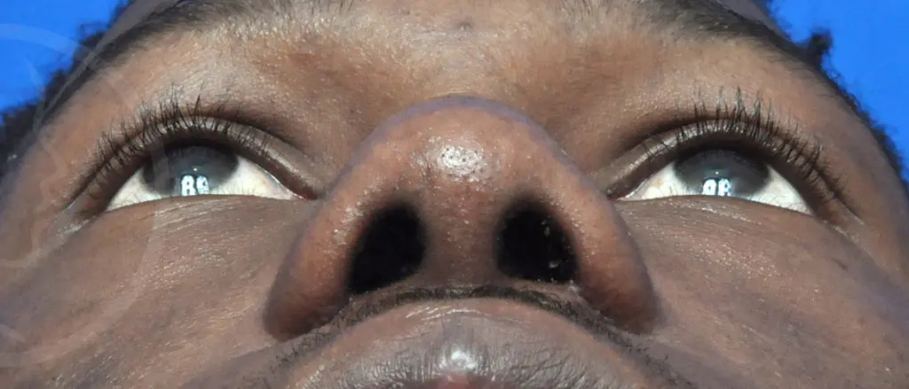 Plastic Surgery Before and After Pictures in Jacksonville, FL - Garcia Facial Plastic Surgery