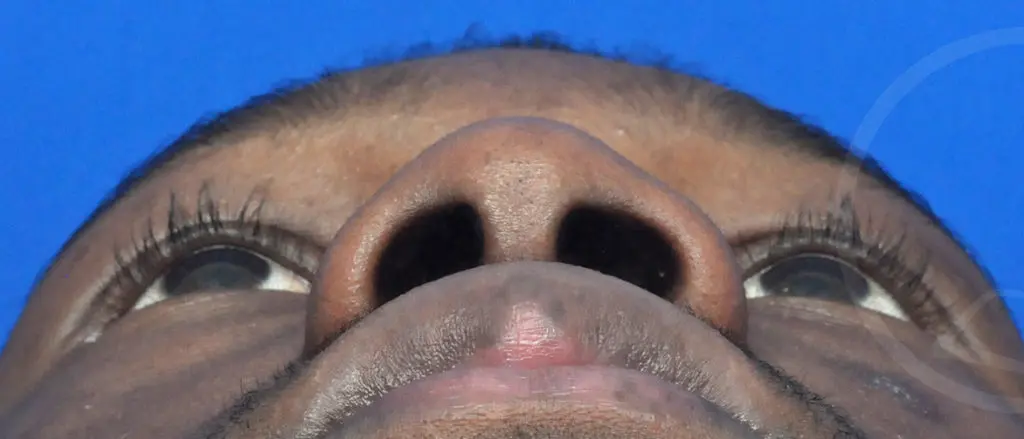 Plastic Surgery Before and After Pictures in Jacksonville, FL - Garcia Facial Plastic Surgery