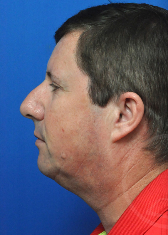 Plastic Surgery Before and After Pictures in Jacksonville, FL - Garcia Facial Plastic Surgery