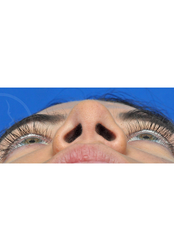 Plastic Surgery Before and After Pictures in Jacksonville, FL - Garcia Facial Plastic Surgery