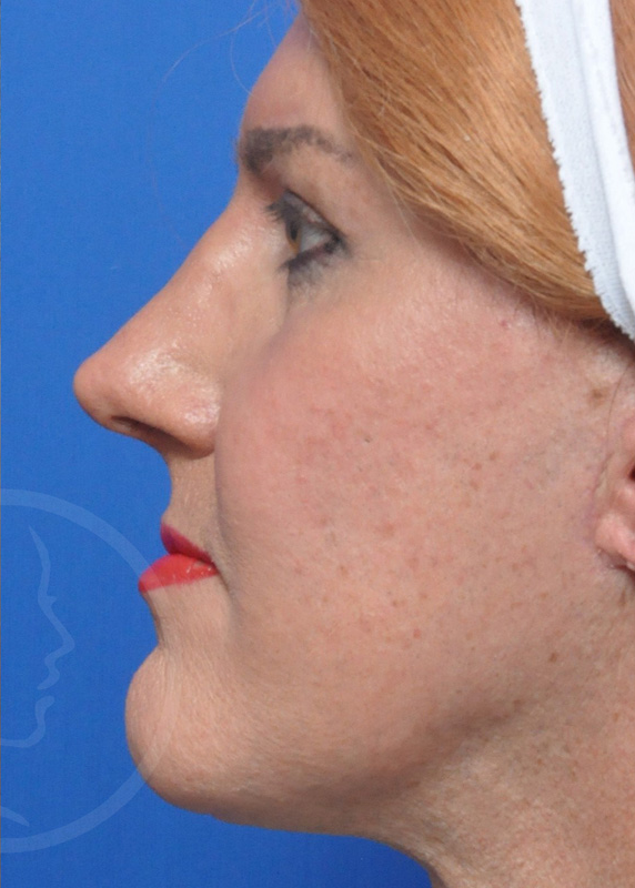 Plastic Surgery Before and After Pictures in Jacksonville, FL - Garcia Facial Plastic Surgery