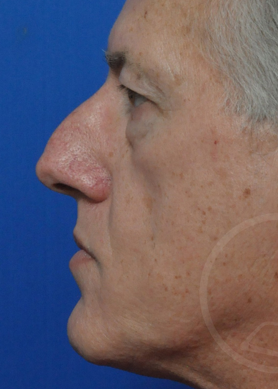 Plastic Surgery Before and After Pictures in Jacksonville, FL - Garcia Facial Plastic Surgery