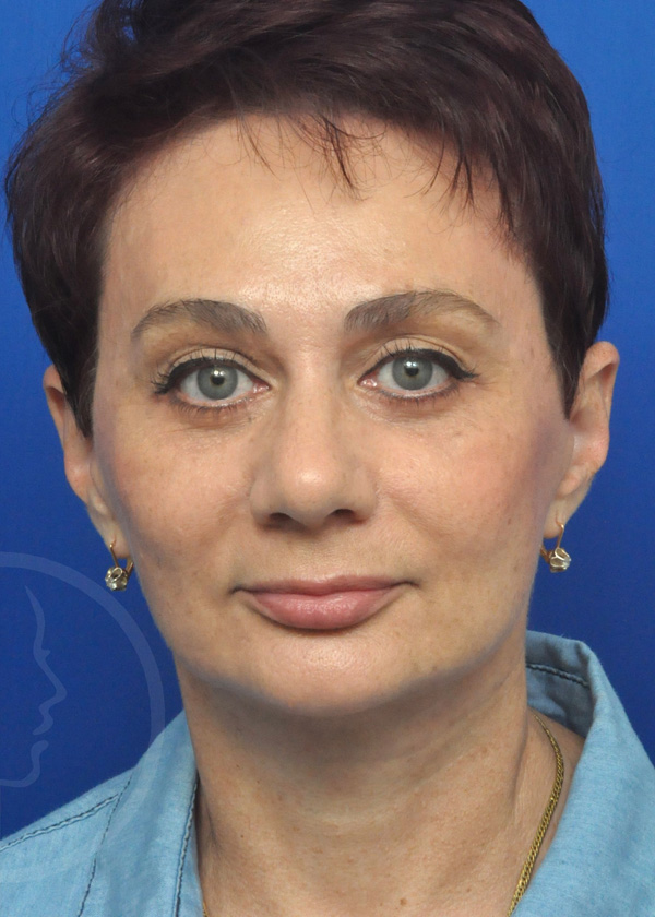 Plastic Surgery Before and After Pictures in Jacksonville, FL - Garcia Facial Plastic Surgery