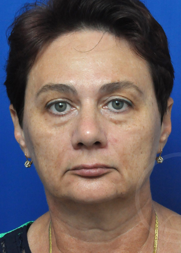 Plastic Surgery Before and After Pictures in Jacksonville, FL - Garcia Facial Plastic Surgery