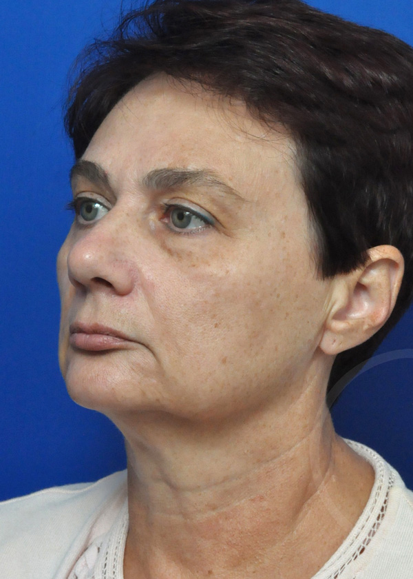Plastic Surgery Before and After Pictures in Jacksonville, FL - Garcia Facial Plastic Surgery