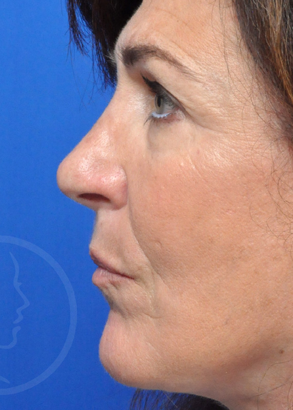 Plastic Surgery Before and After Pictures in Jacksonville, FL - Garcia Facial Plastic Surgery