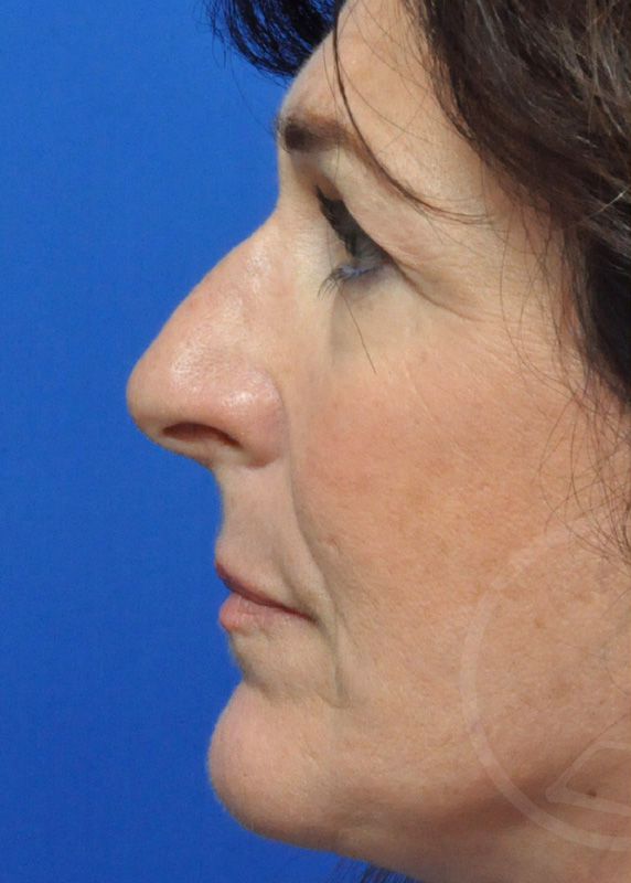 Plastic Surgery Before and After Pictures in Jacksonville, FL - Garcia Facial Plastic Surgery